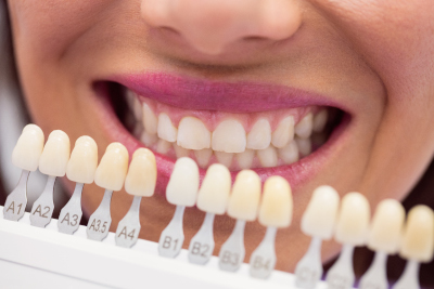 blanchiment-dentaire-risque-avec-les-dents-cariees-dentiste-roissy-en-brie