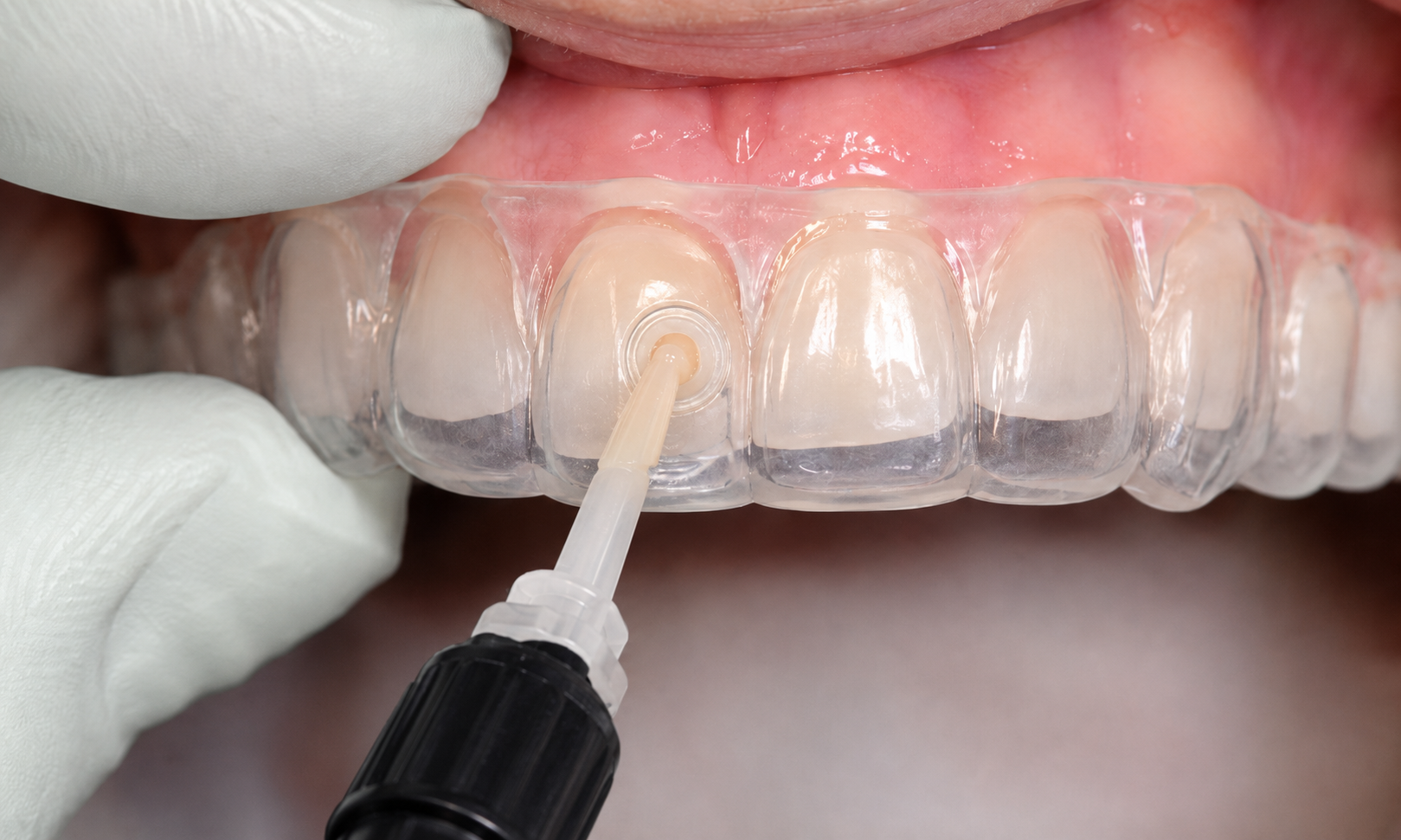 techniques-empreintes-dentaires-optiques-dentiste-roissy-en-brie